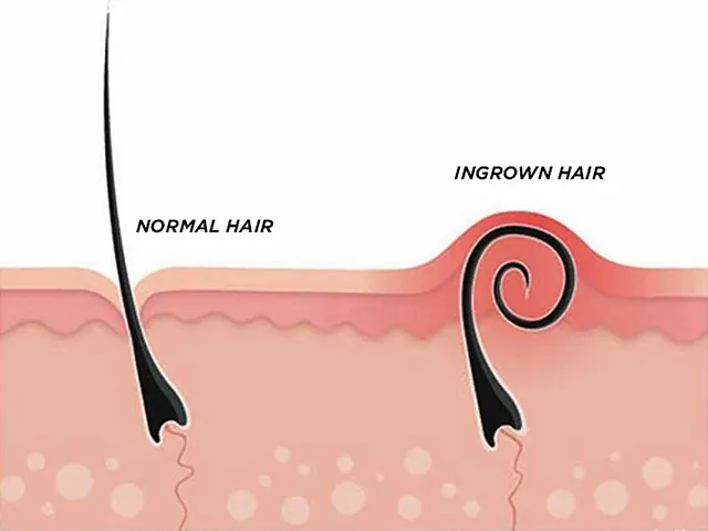 Preventing Ingrown Hairs After Waxing- Tips and Tricks